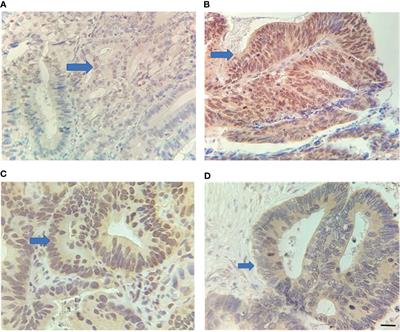 Combined Detection of RUNX3 and EZH2 in Evaluating Efficacy of Neoadjuvant Therapy and Prognostic Value of Middle and Low Locally Advanced Rectal Cancer